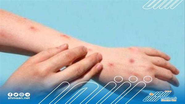 أكثر من الفي إصابة بجدري القرود في هذه البلاد لهذا السبب..!