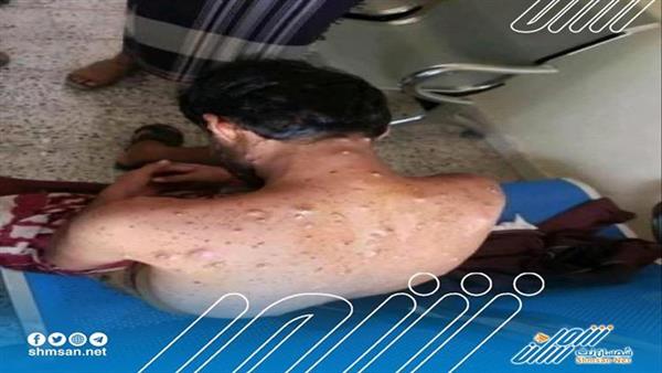 صور لحالات اشتباه بجدري القرود في عدد من المحافظات تثير فزع وقلق شعبي كبير 
