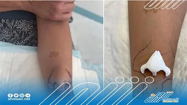 نجاح عملية زرع أنف على وجه امرأة بعد أن نُمِّي على يدها في فرنسا