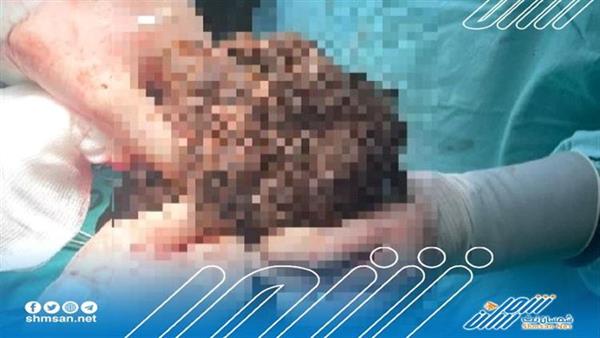 الأطباء يستخرجون كتلة من الشعر وزنها 3 كغم من معدة فتاة
